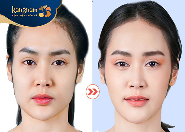 Khách hàng sở hữu cằm Vline thon gọn