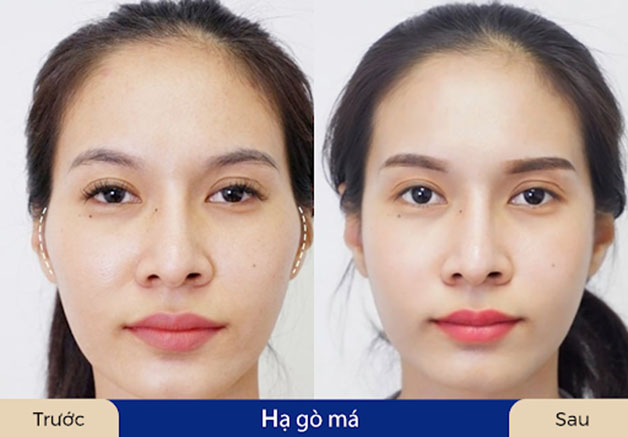 Gương mặt mềm mại hơn sau khi gạ gò má