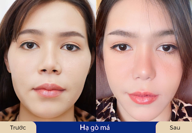 Trẻ hóa gương mặt sau khi hạ gò má