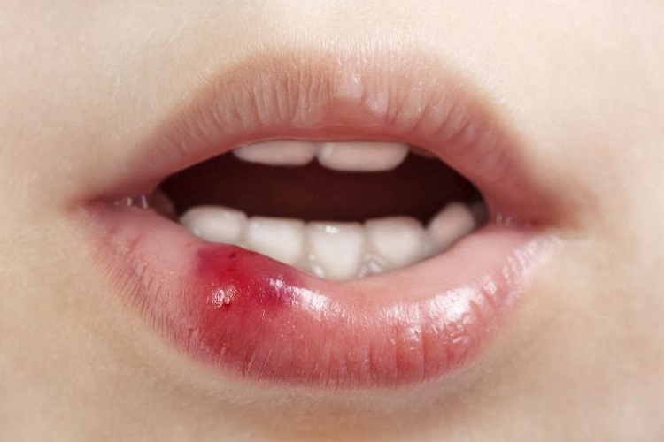 Môi bị nổi mụn nước do nhiễm virus