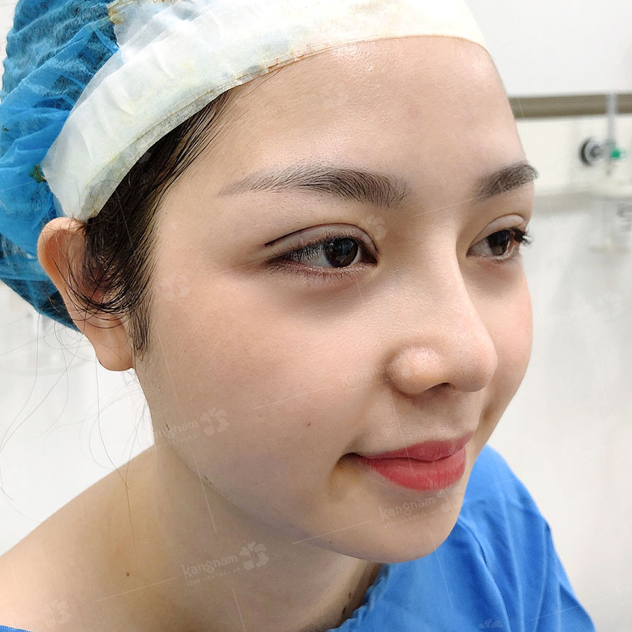 Dáng mũi tự nhiên và mềm mại