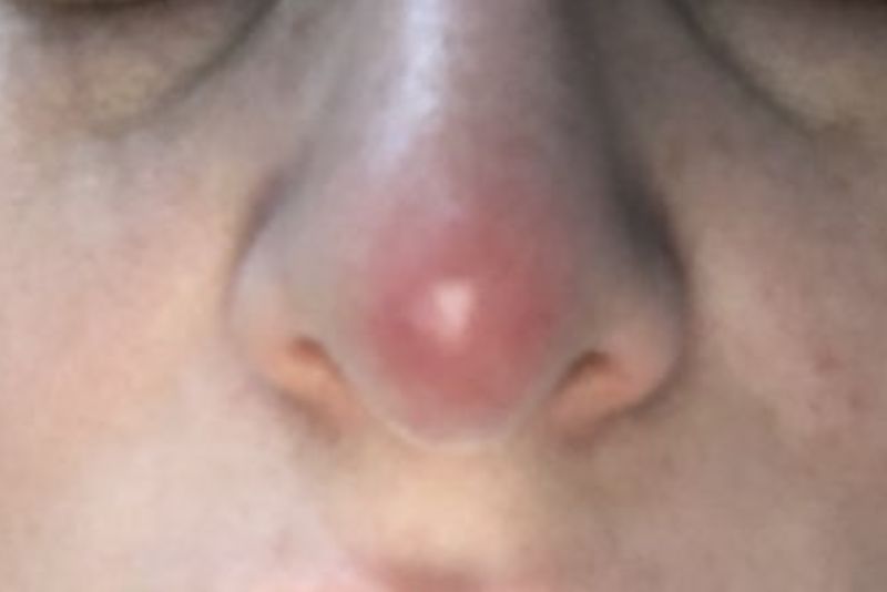 Không trang điểm khi mũi có dấu hiệu sưng đỏ