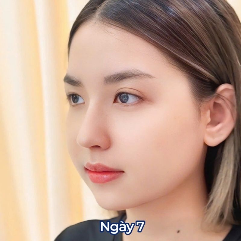 Da mũi ổn định, không bong tróc sau 7 ngày nâng mũi