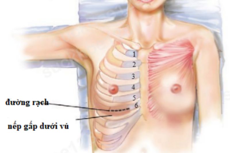Sẹo khó thấy và sẽ mờ dần sau phẫu thuật