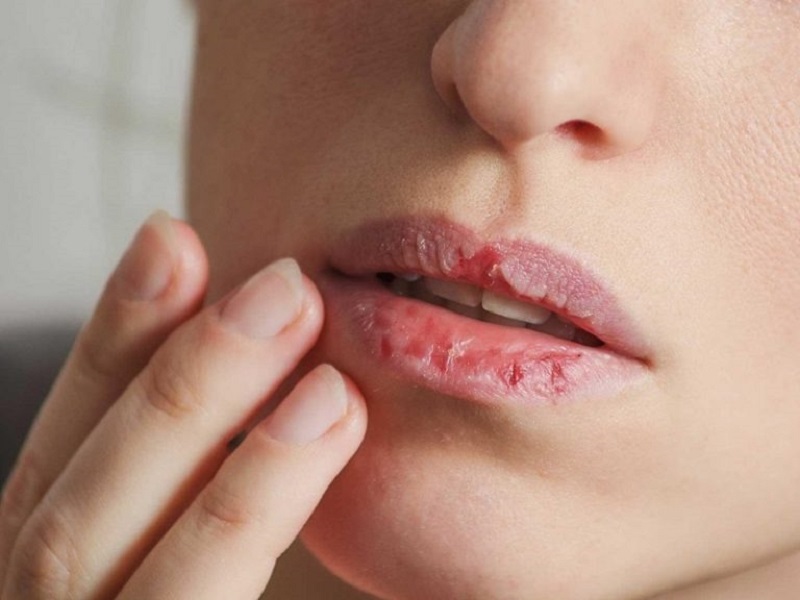 Môi bị ngứa sau phun môi là hiện tượng thường gặp