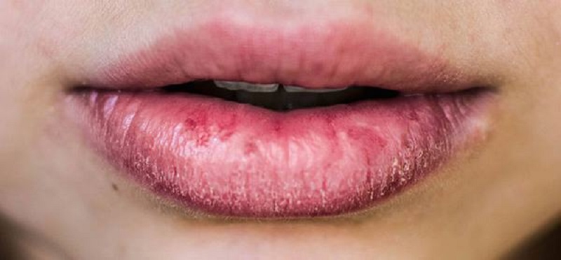 Theo dõi những trình trạng bất thường sau khi phun môi