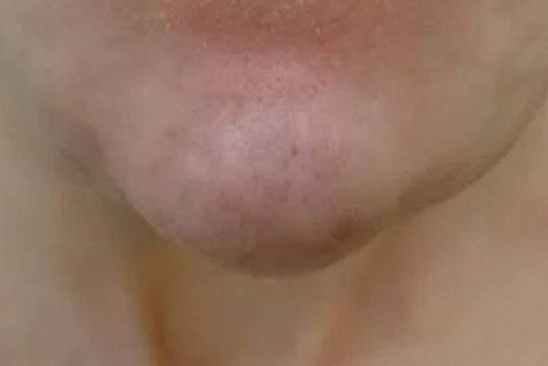 Tiêm filler bị lệch ảnh hưởng đến thẩm mỹ