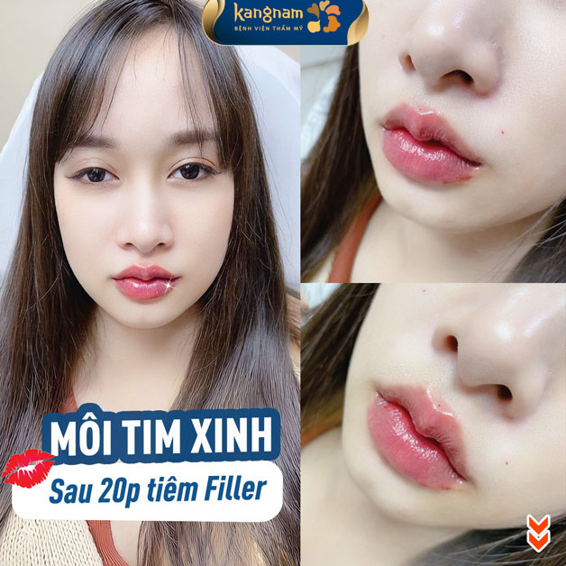 Môi xinh mềm mại sau tiêm filler
