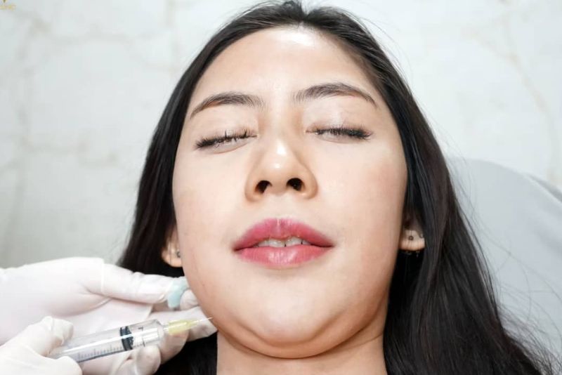 Tiêm giảm mỡ mặt không cần nghỉ dưỡng