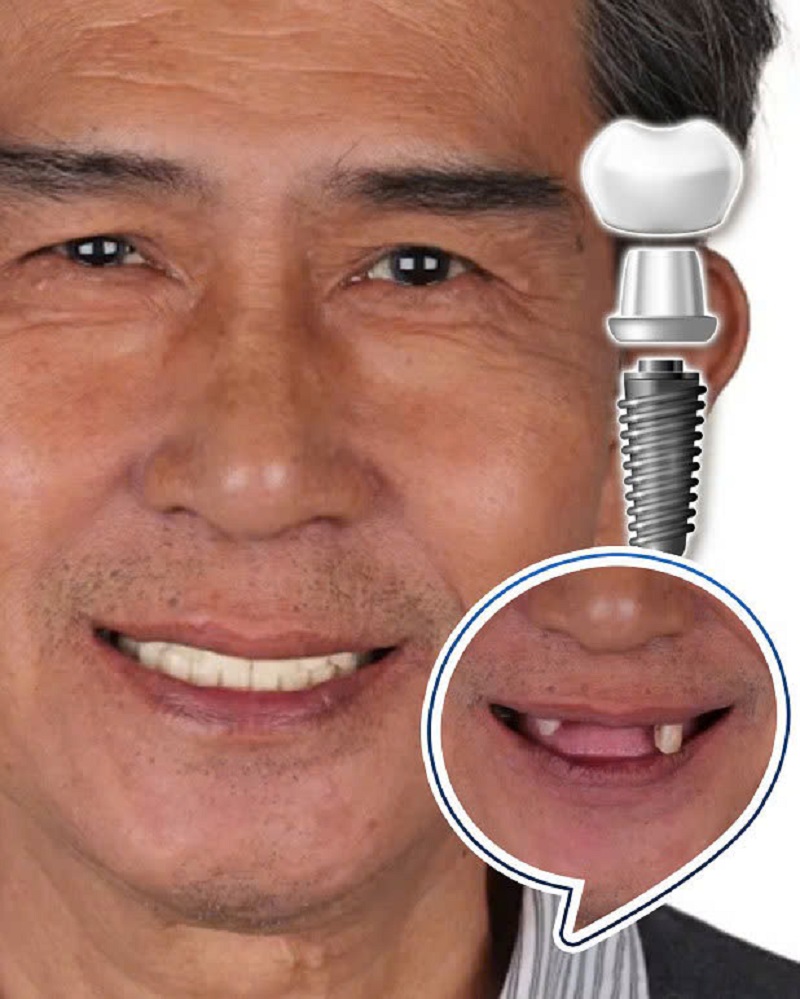 Trồng răng Implant và bọc răng sứ tại Bệnh viện Thẩm mỹ Kangnam