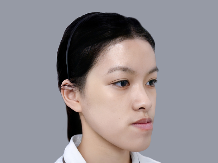 khách hàng Kangnam gặp tình trạng móm do xương, hàm dưới nhô ra trước hàm trên