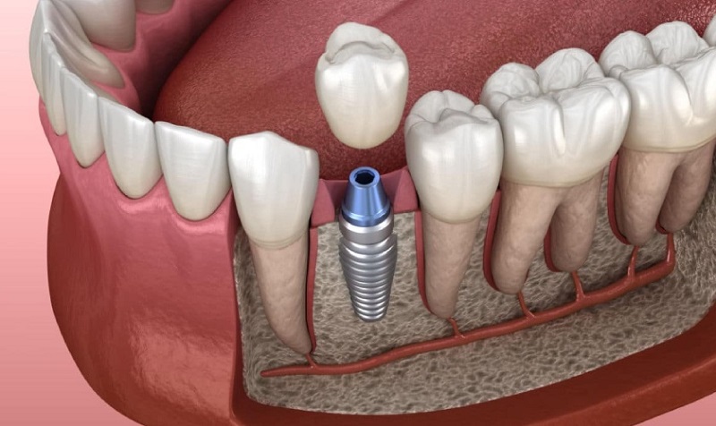 Trồng răng Implant tại Bệnh viện Răng Hàm Mặt giúp đảm bảo an toàn