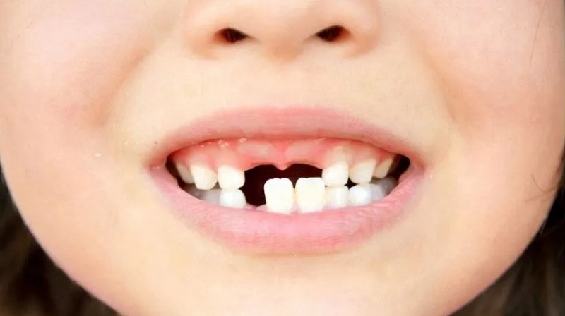 Trẻ em không nên trồng răng quá sớm sẽ ảnh hưởng đến sự phát triển của răng