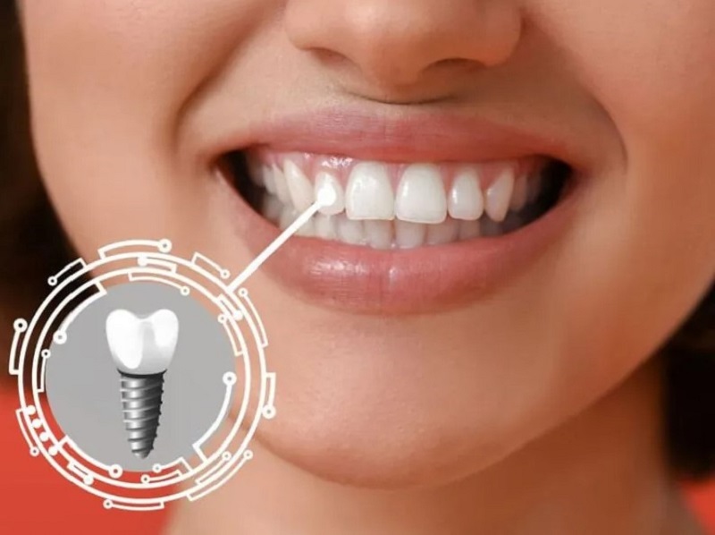 Khi đủ tuổi có thể trồng Implant để cải thiện chức năng ăn nhai và tính thẩm mỹ