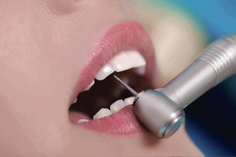 Bác sĩ có kỹ thuật tốt sẽ mài răng chính xác