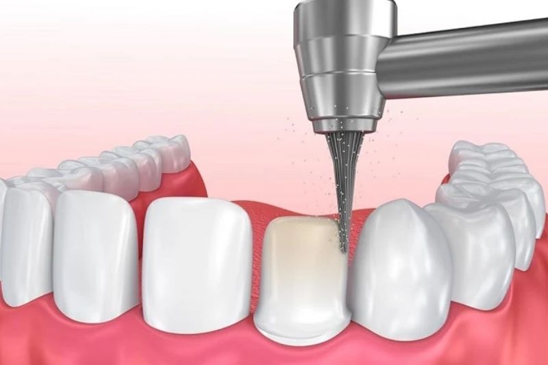 Mài răng bọc sứ không khó chịu
