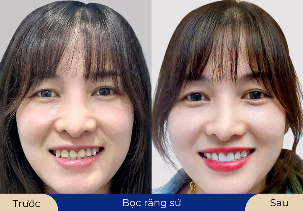 Khách hàng sở hữu hàm răng trắng sáng sau khi bọc mão sứ