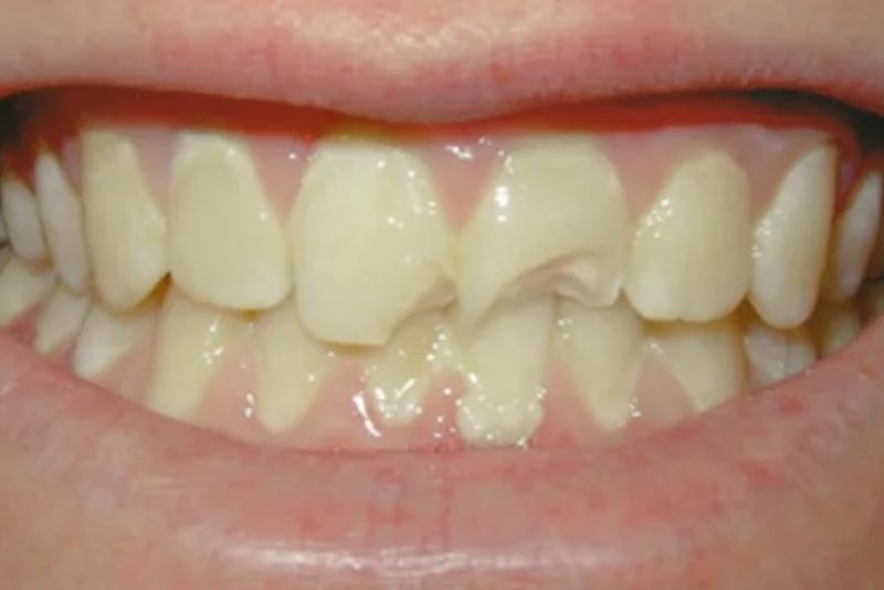 Tuổi thọ kém hơn răng thật