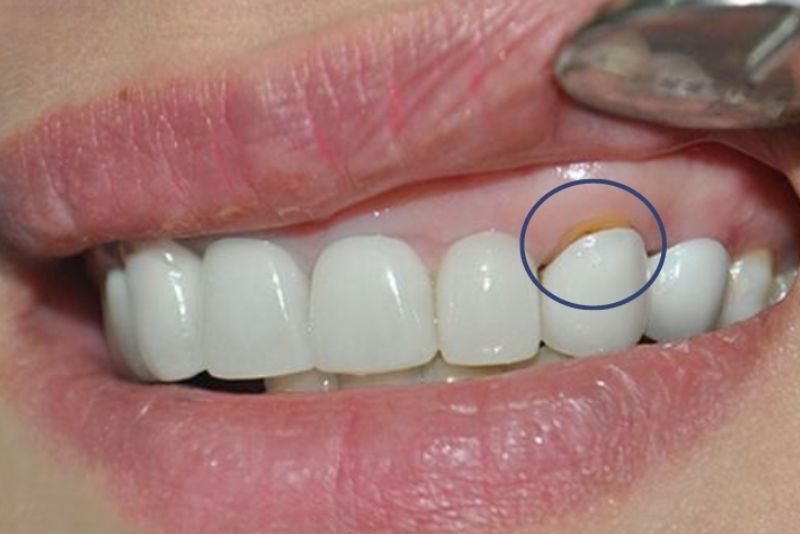 Đen xỉn viền nướu sau một thời gian sử dụng