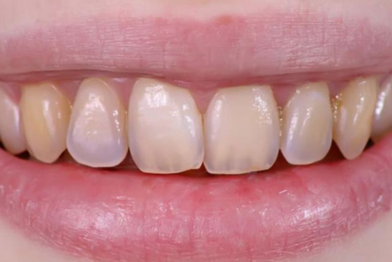 Hạn chế khả năng che màu răng thật