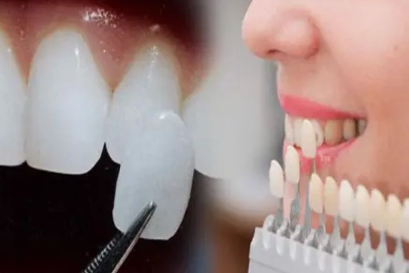 Mặt răng sứ an toàn