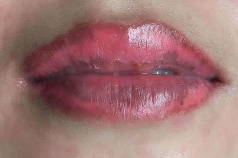 Tình trạng phun môi hỏng cần đến cơ sở thẩm mỹ để được kiểm tra