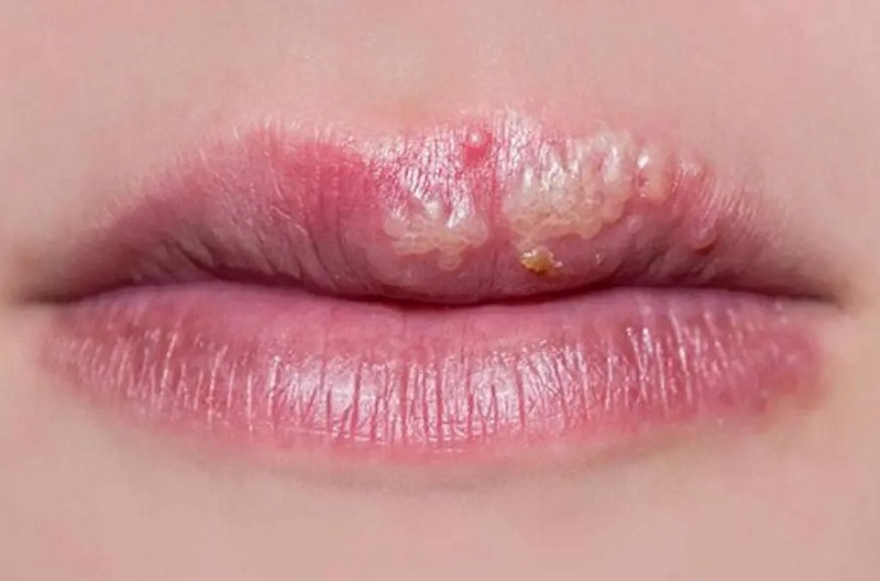 Môi nổi mụn nước có thể phải dùng thuốc kháng sinh và thuốc bôi
