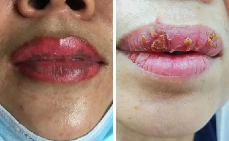 Phun môi bị hỏng dẫn đến môi loang màu hoặc bong vảy không đều