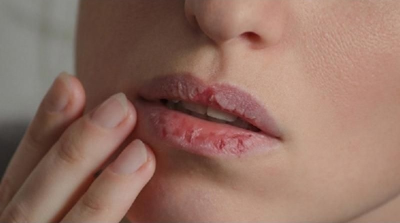 Ủ tê quá thời gian hoặc quá liều lượng sẽ làm cháy môi