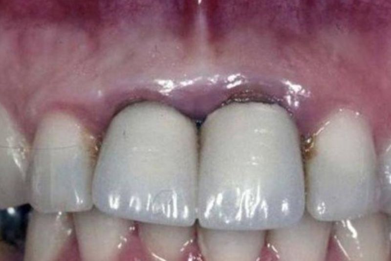 Bệnh lý nướu cũng làm đen viền răng sứ