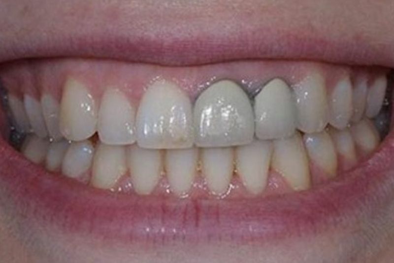 Đen viền nướu khi bọc răng sứ Titan