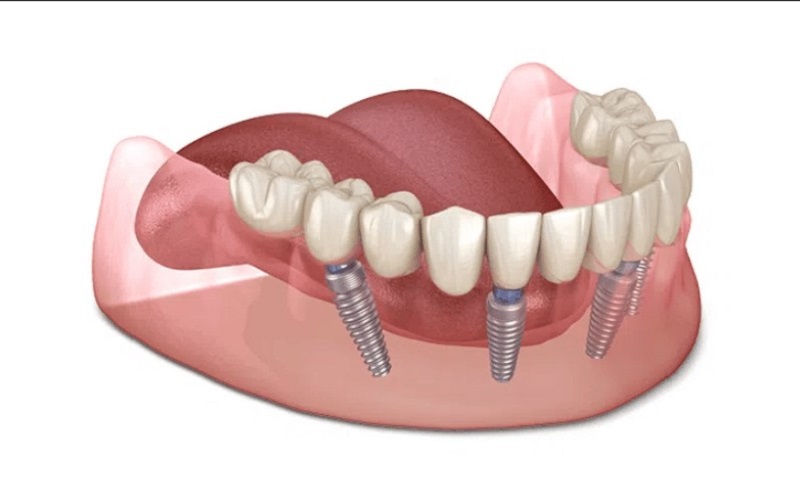 Cần đảm bảo sức khỏe tốt trước khi trồng răng Implant