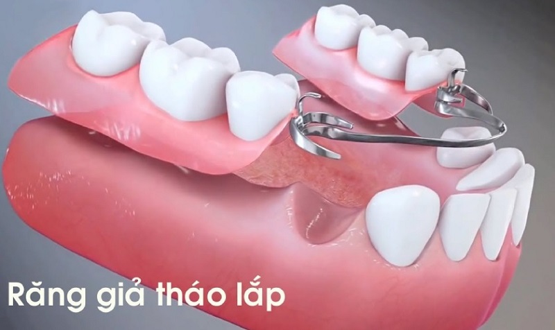 Mẹ bầu có thể dùng răng hàm giả tháo lắp