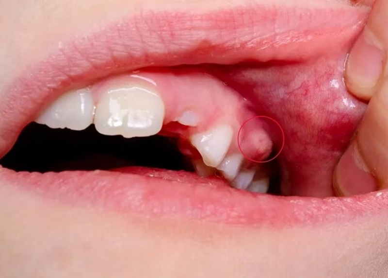 Trường hợp viêm nhiễm, áp xe răng thì nên thăm khám sớm