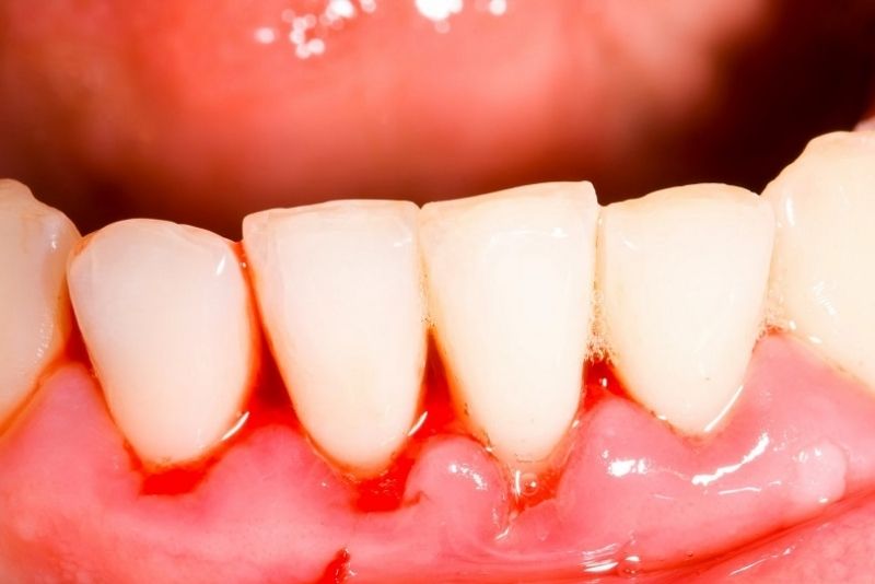 Nên điều trị viêm nha chu rồi mới bọc răng sứ