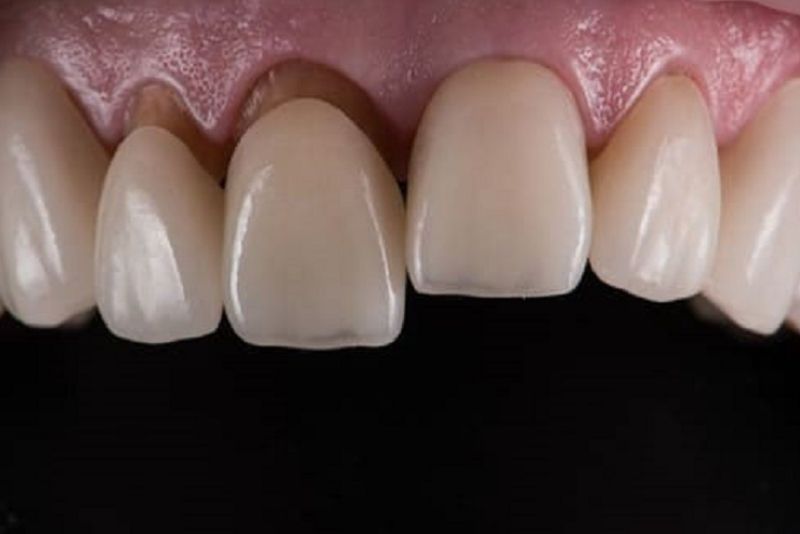 Bọc răng sứ giá rẻ khoảng 500k dễ bị hư hỏng