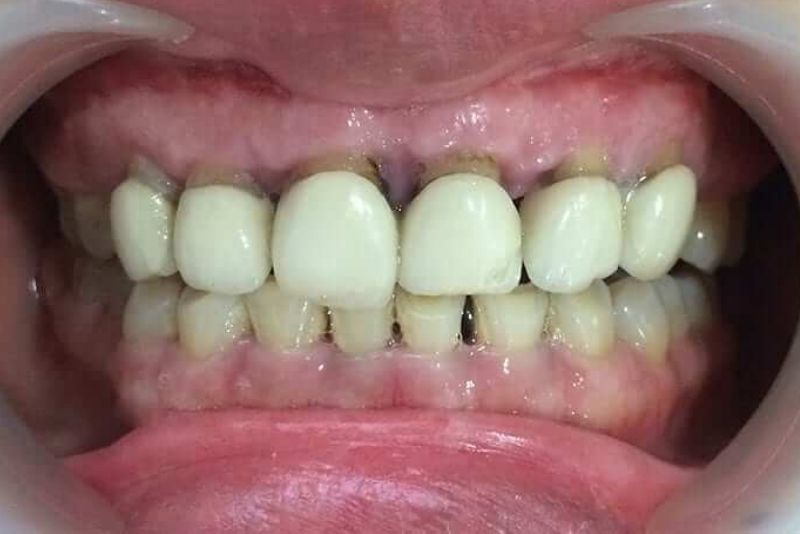 Bọc răng sứ giá rẻ đen viền nướu