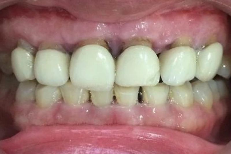 Răng sứ kém chất lượng