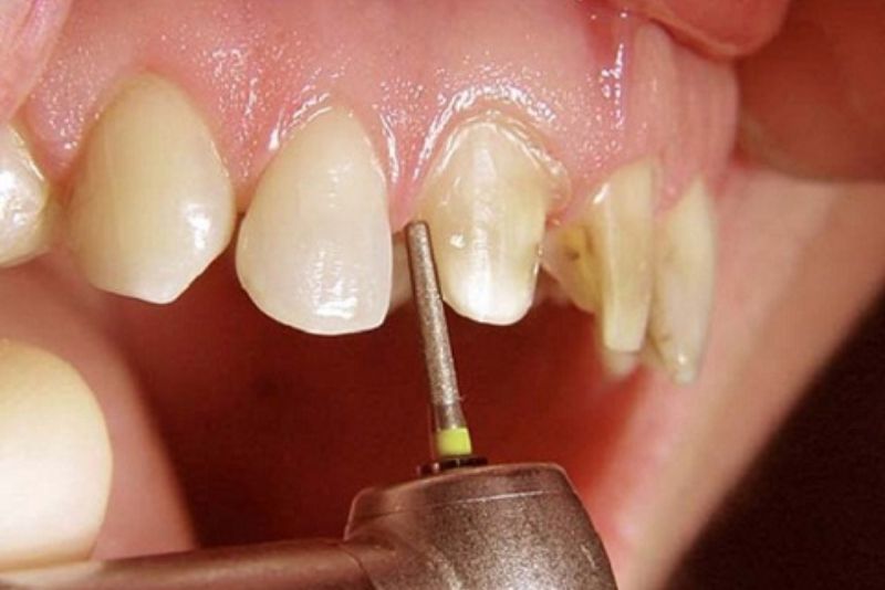 Khi mài răng bọc sứ không hề đau