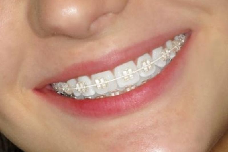 Mão sứ còn chắc chắn thì vẫn có thể niềng răng