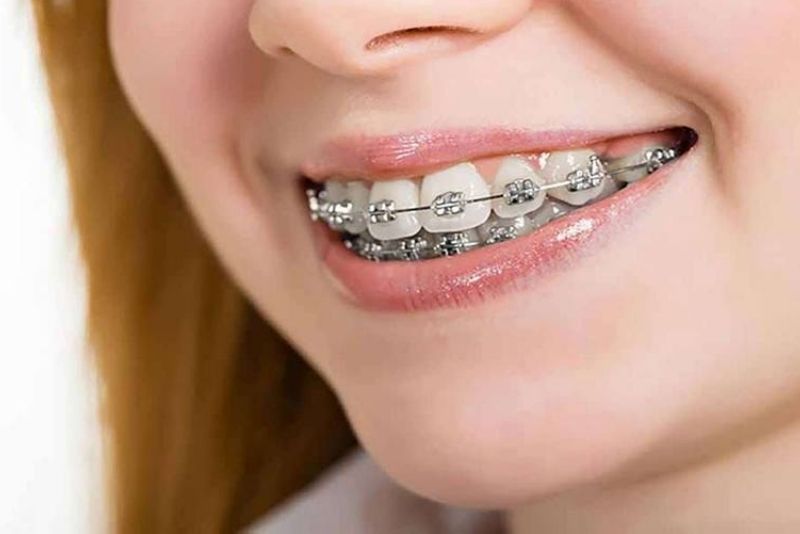 Sau khi bọc sứ vẫn có thể chỉnh nha