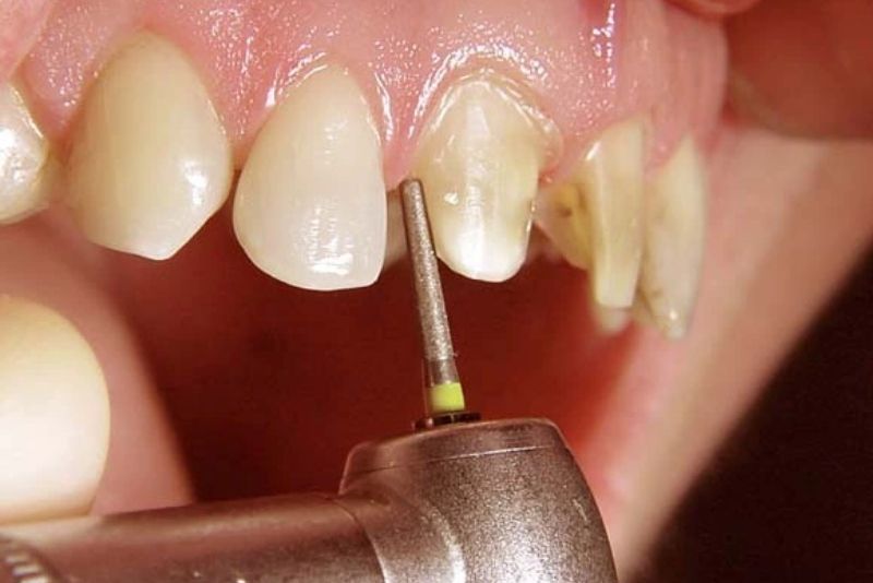 Răng sứt mẻ hoặc hô nhẹ nên mài răng