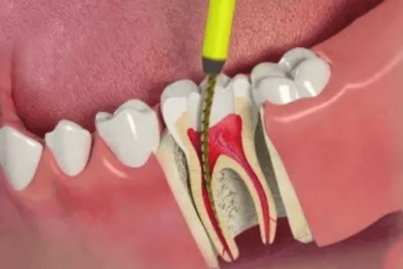 Răng thật đã điều trị tủy