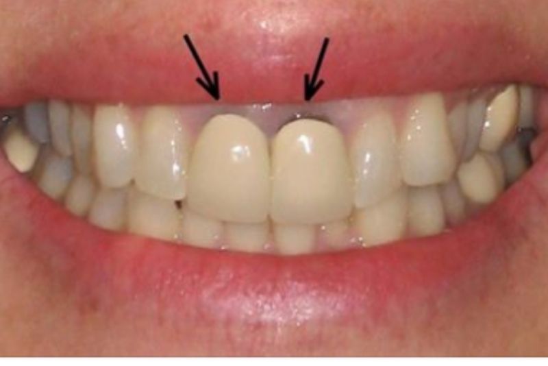 Nướu thâm đen sau khi bọc sứ