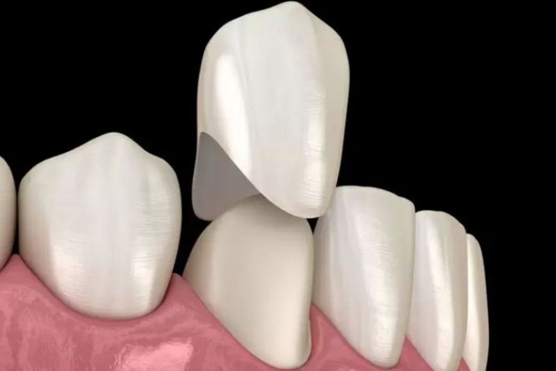 Răng sứ có thể tháo ra được