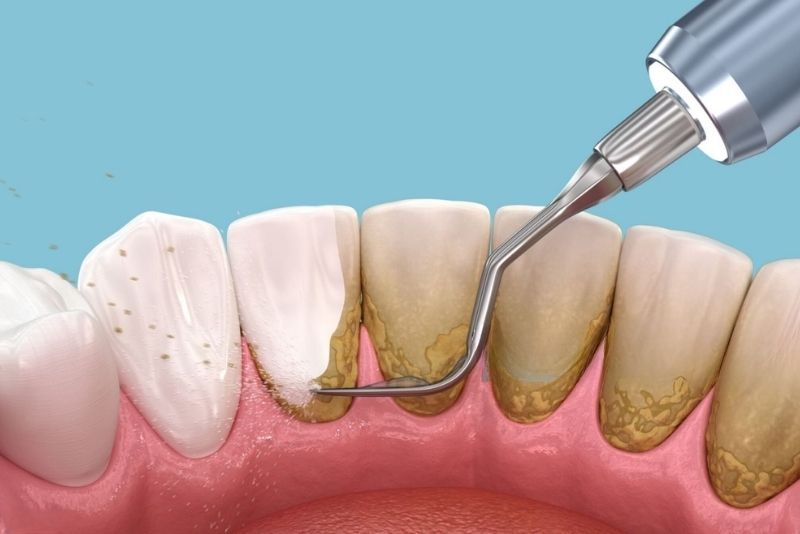 Lấy cao răng định kỳ tại nha khoa