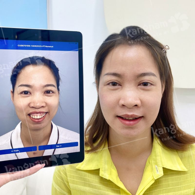 Hô nặng cần phẫu thuật hàm