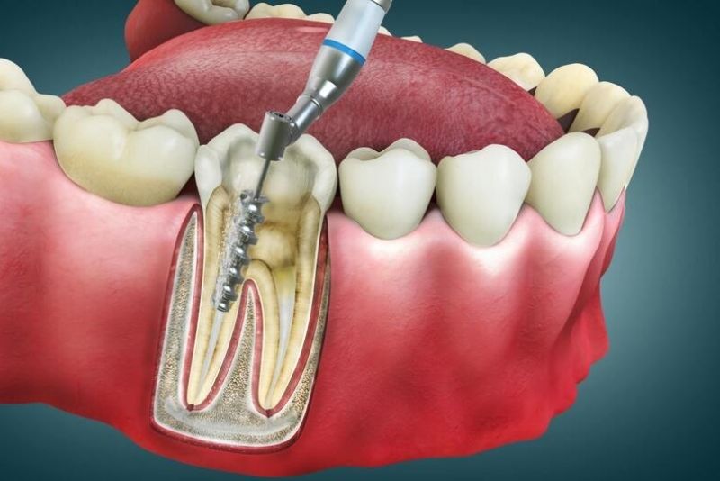 Nên bọc sứ sau khi lấy tủy răng