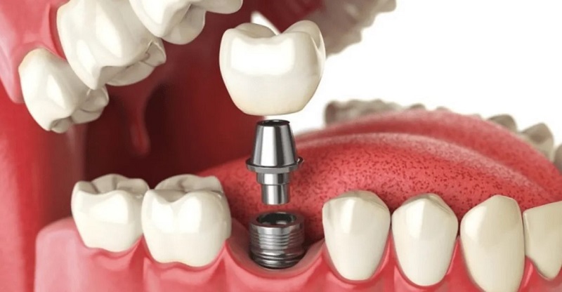 Khách hàng nên trồng răng cấm sau khi bị mất răng