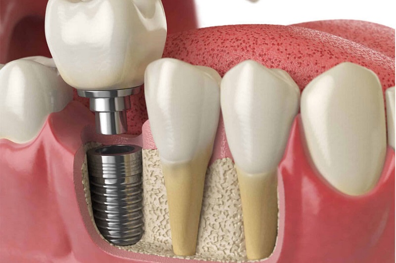 Trồng răng Implant là giải pháp tối ưu hiện nay